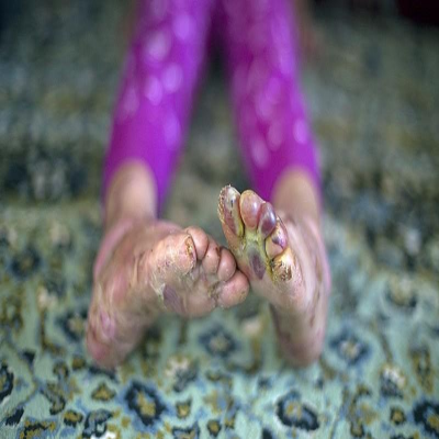 حمایت مستمر از بیماران اوتیسم، پروانه‌ای و پی‌کی‌یو در اسدآباد